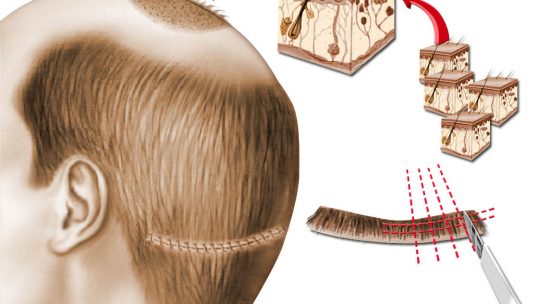 Chirurgie esthétique de la calvitie et greffe de cheveux