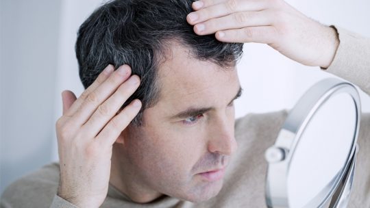 Calvitie et perte de cheveux – Traitement de prévention contre l’alopécie